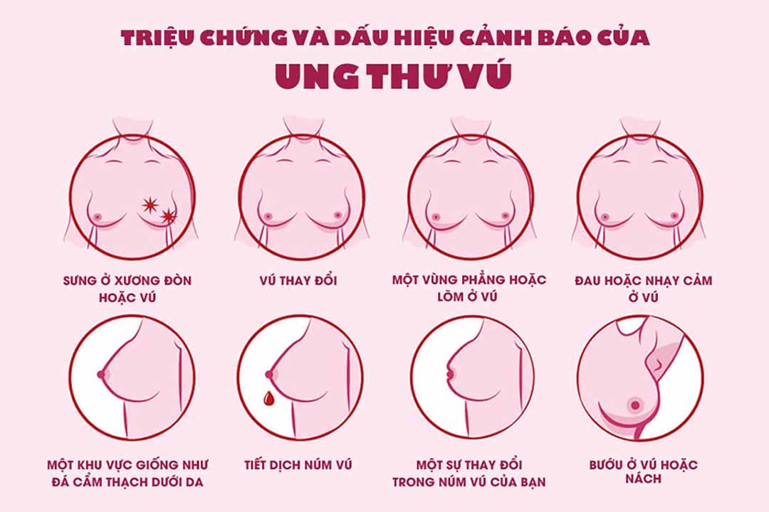 Ung thư vú – Nguyên nhân, triệu chứng và phương pháp điều trị 